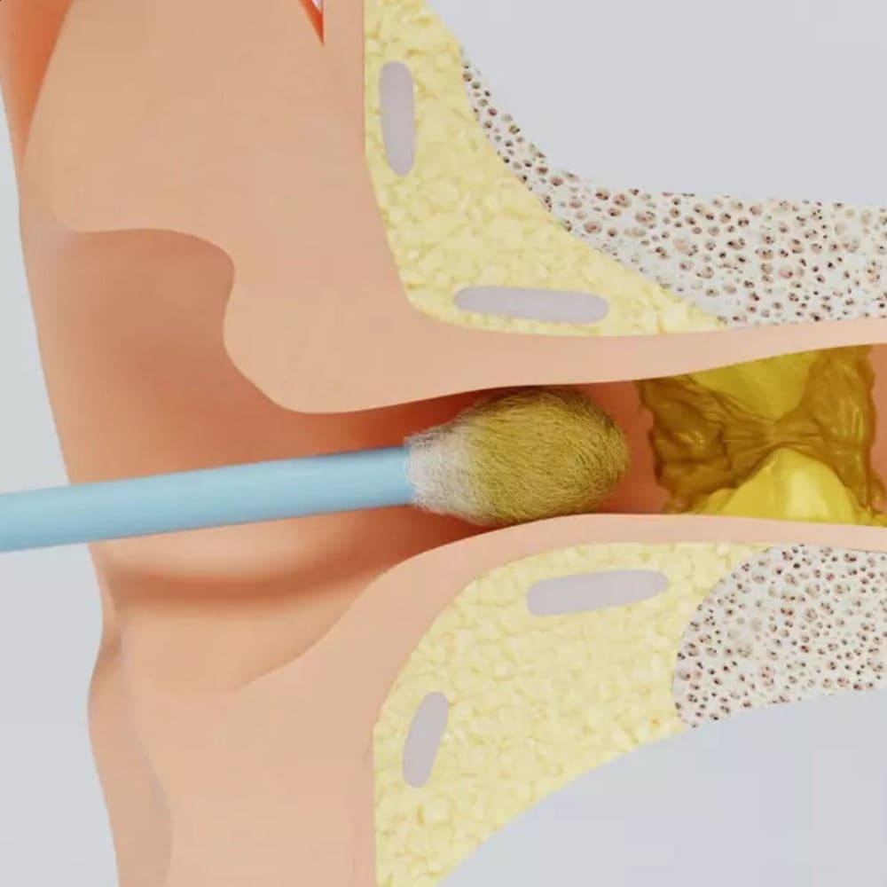 Les Dangers Cachés des Cotons-Tiges pour les Oreilles